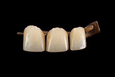 Bridge Work, False Teeth