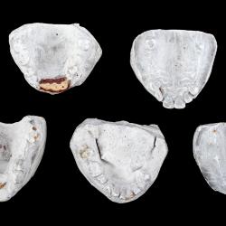 Models, Plaster Of Upper Jaw, Before And After, Also One Wax Model  Of The Lower Jaw