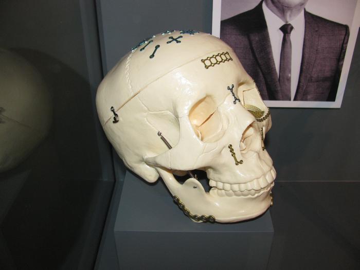 Craniomaxillofacial Skull